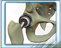 Stryker hip recall lawsuit attorney with proven results in Stryker, Depuy Metal on Metal implant cases